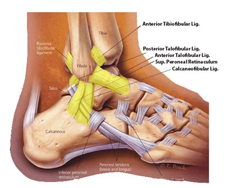 Anterior Tibiofibular Ligament Tear