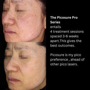 Pigmentation Treatment With The Picosure Laser | Dr Davin Lim