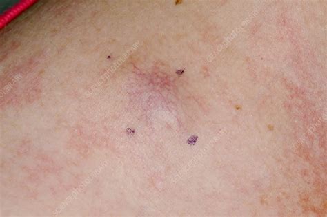 Melanoma Skin Cancer On Chest