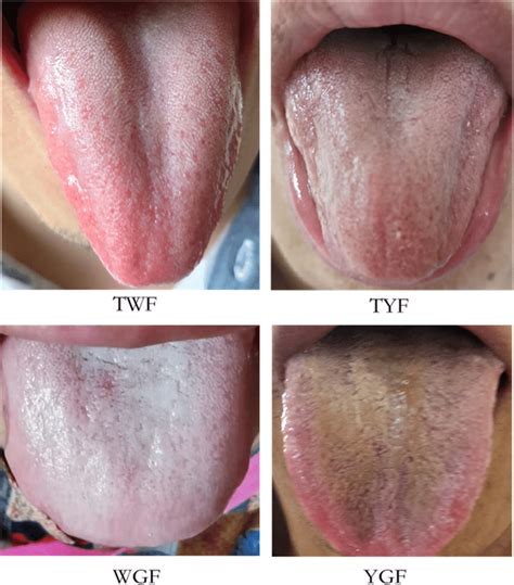 Chinese medicine tongue coating types and photos. Tongue coating: a ...