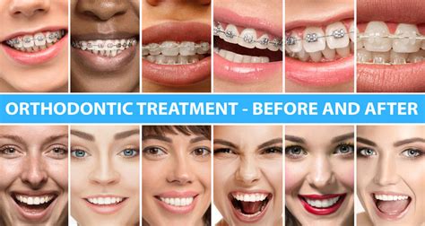 SmileDirectClub VS Invisalign: Which is better in 2024