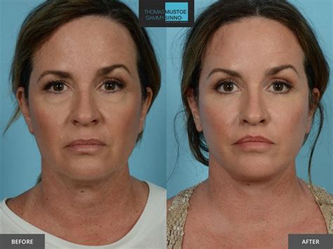 8 Facelift Before-and-After Photos That Prove Just How Natural Today’s Results Look | TLKM ...