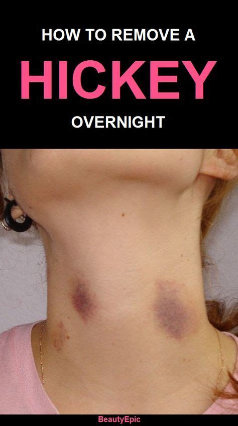 Top 10 Easy Ways to Get Rid of a Hickey Overnight | Hickeys, Hickies, Hickies neck