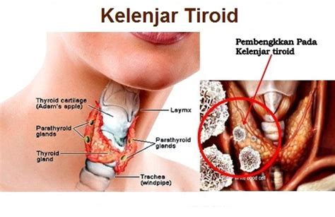 Cara Mengobati Kelenjar Tiroid Bengkak Dan Sakit | AHLINYA PENGOBATAN ALAMI