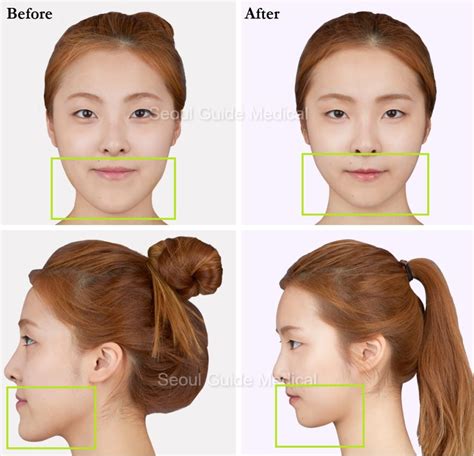 Before And After Double Jaw Surgery - Seoul Guide Medical