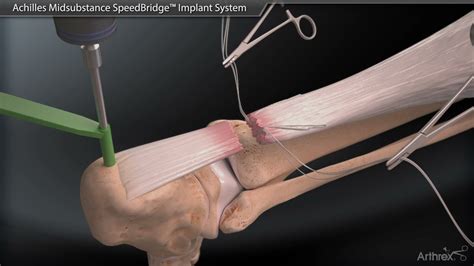 Achilles Midsubstance SpeedBridge™ Implant System - YouTube