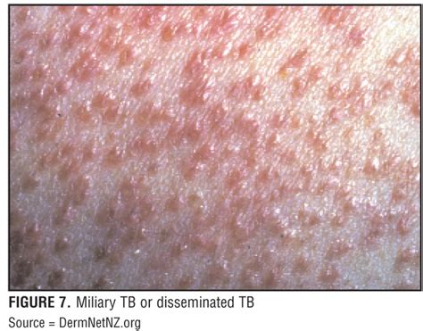 Tuberculosis Skin Symptoms