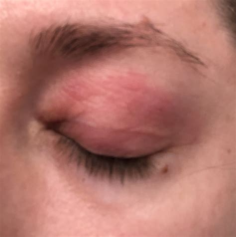 Cara Tenenbaum on Twitter: "Allergic reaction on my eyelid so bad I ...