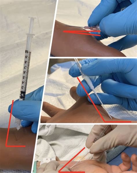 Just-in-Time Training for Radial Arterial Line Placement