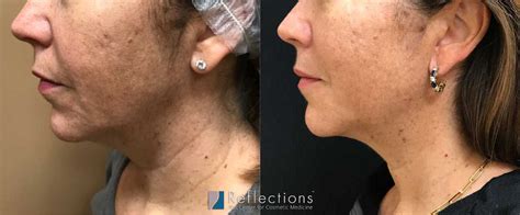 Non-Surgical Facelift with Ulthera, Sofwave, Radiesse, and Liquid ...