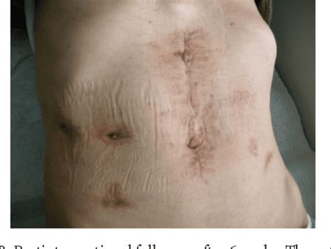 Figure 1 from Endoscopic Treatment of a Gastrocutaneous Fistula Using the Over-The-Scope-Clip ...