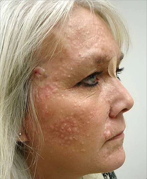 Numerous Facial Lesions in a 47-Year-Old Woman—Quiz Case | Dermatology ...