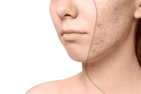 Acne Scars – What are my Treatment Options? - Northstar Dermatology