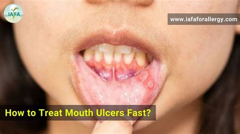 How to Treat Mouth Ulcers Fast?