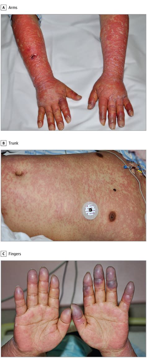 Bullous and Exanthematous Lesions Associated With Chimeric Antigen ...