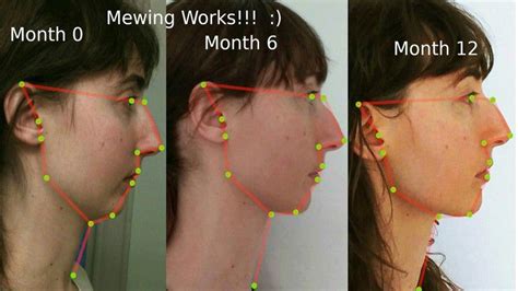 Mewing Is the Fringe Orthodontic Technique Taking Over YouTube Jaw ...