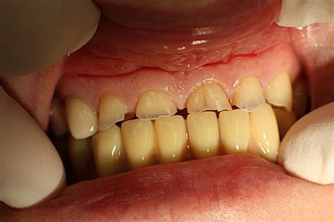 Dental Erosion from Abrasion & Abfraction | Postgraduate Dentistry