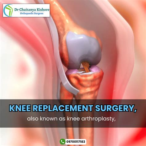 Knee replacement surgery – Dr Chaitanya Kishore