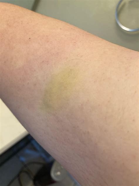 Yellow spot on my upper arm. I thought it was a bruise at first, but it ...