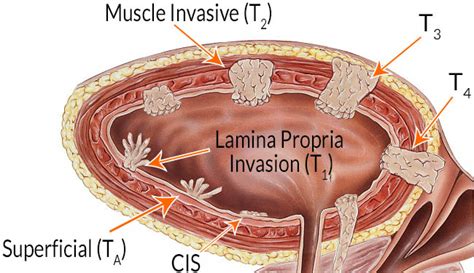 Bladder Cancer Tumor