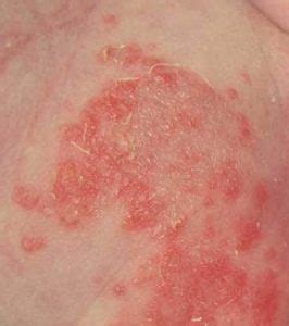 Fungal Skin Rash Yeast