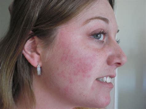 Close up Butterfly rash | Melissa Fairchild | Flickr