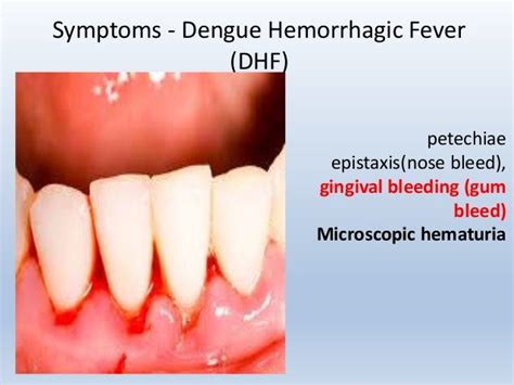 Dengue Hemorrhagic Fever Symptoms