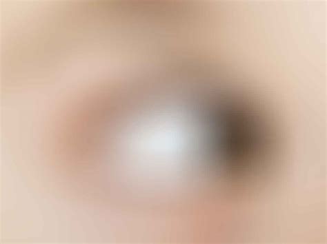 What is Exotropia? How Common is it?