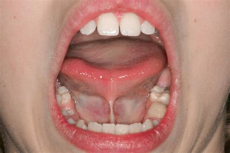 Abnormal Frenum Attachments In Children | Homeopathic Dentistry