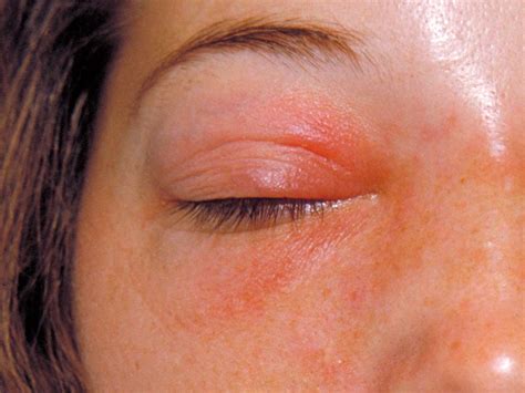 Cellulitis Orbital