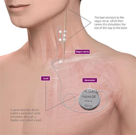 Vagus Nerve Stimulation Side Effects