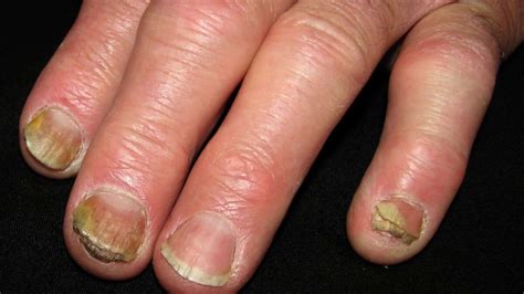 Causes Of Nail Infections Eczema - AtoAllinks