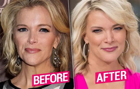 Did Megyn Kelly Have Plastic Surgery? Megyn Kelly Before and After Face ...