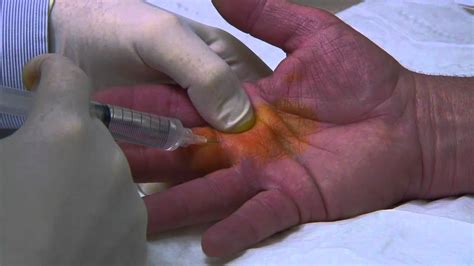 Percutaneous Trigger Finger Release : Donald Ditmars MD, FACS - YouTube