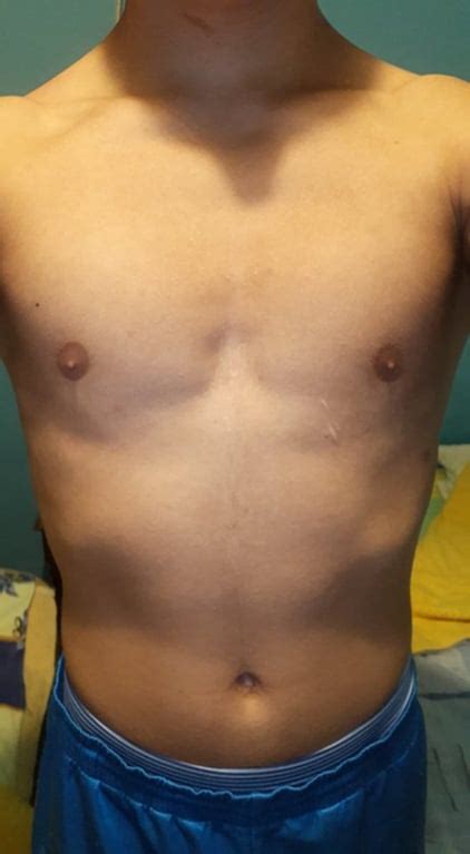 Pectus Excavatum