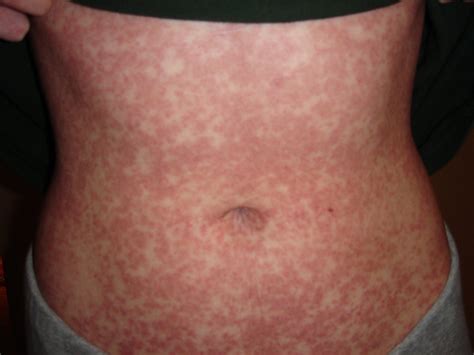 Mononucleosis Amoxicillin Rash - Https Www Amjmed Com Article S0002 9343 14 00810 9 Pdf : .among ...