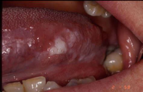 Leukoplakia – European Association of Oral Medicine