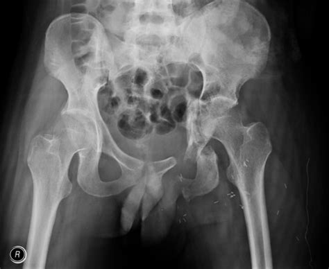 Fracture of Superior and Inferior Pubic Rami, Ischium, and Acetabulum ...