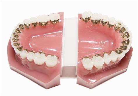 Lingual Braces – sinanak.com