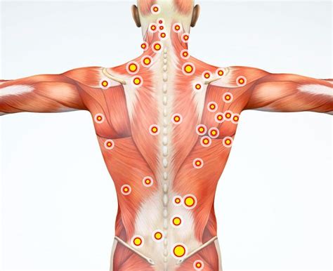 Spine Muscle Pain and Myofascial Syndrome