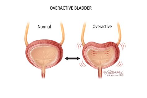 What Are the Causes of OAB? - Urology Care Foundation