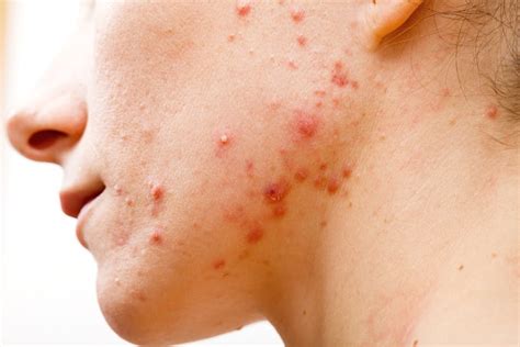 Acne treatment: antibiotics don’t need to kill bacteria to clear up your skin