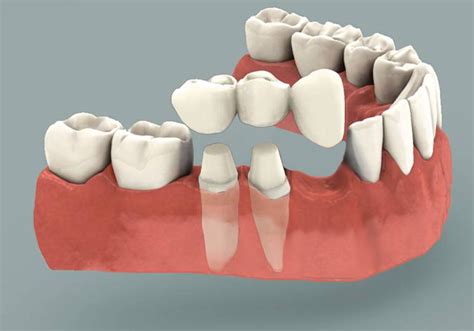 Cantilever Dental Bridge