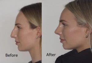 Nasal Dorsum Surgery – Rhinoplasty to Correct the Nose Bridge - Dr Jeremy Hunt