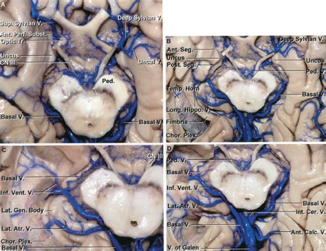 Inferior View of the Basal Cisterns | Neuroanatomy | The Neurosurgical ...