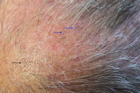 Lichen Planus Treatment in Atlanta — Hair Loss Treatment Clinic — Nina Ross - Atlanta Trichology