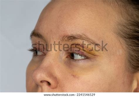 Woman Face Recovery After Plastic Surgery Stock Photo 2241546529 ...