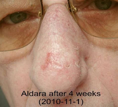 Imiquimod Cream Aldara For Superficial Basal Cell Carcinoma - world of ...