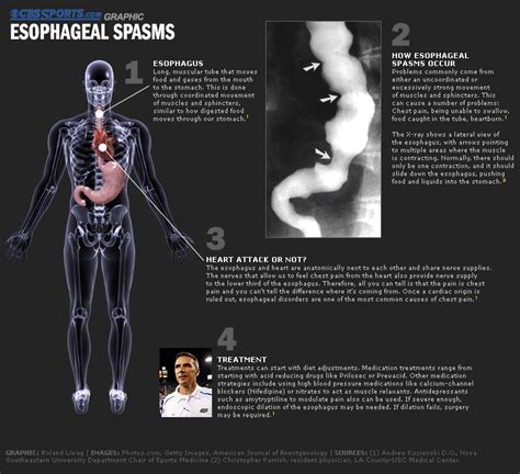 Esophageal spasms Esophageal Spasm, Gerd, Fibro, Healthy Fitness, Self ...