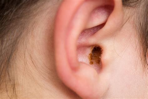 Why You Should Remove Ear Wax Blockages | Moor Hearing